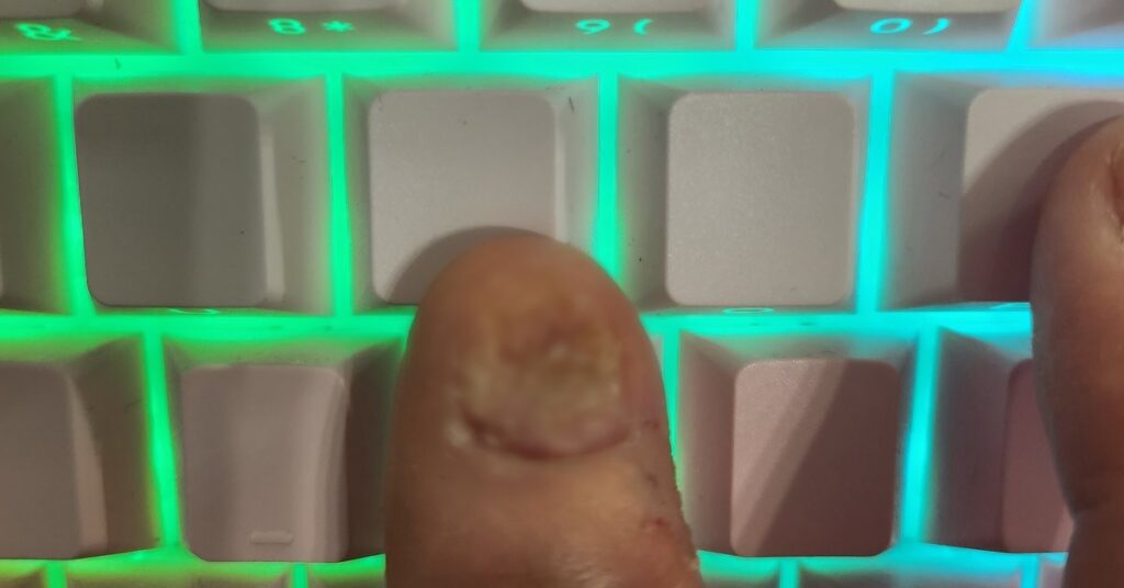 A bitten thumbnail on a backlit RGB keyboard — ADHD nail biting