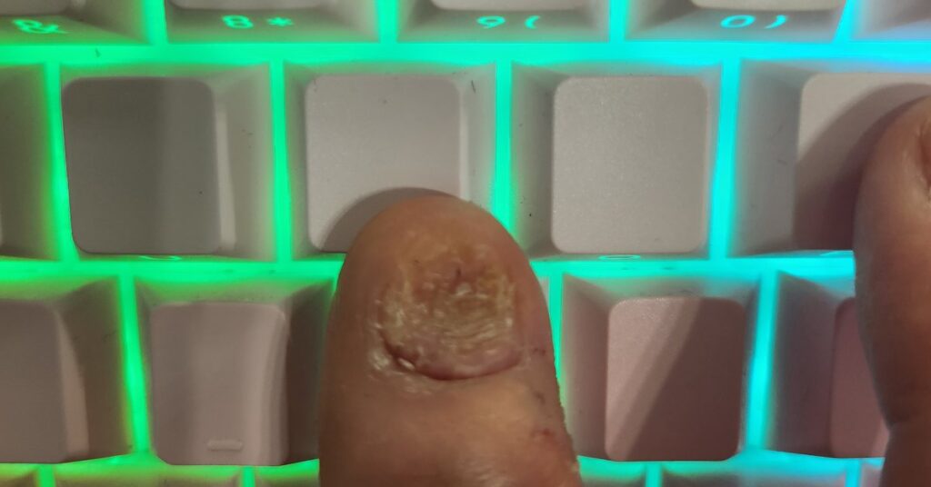 A bitten thumbnail on a backlit RGB keyboard — ADHD nail biting